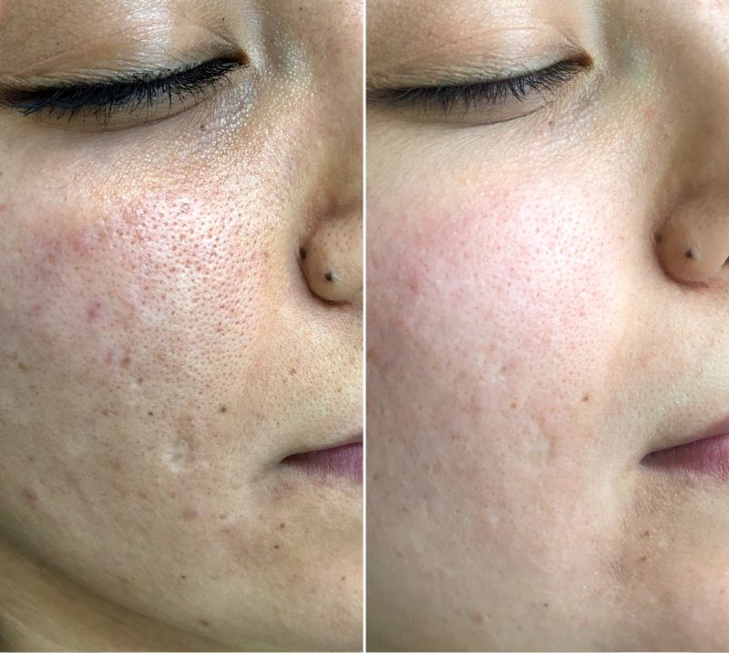 MicroNeedling - before and after, Eye Designer