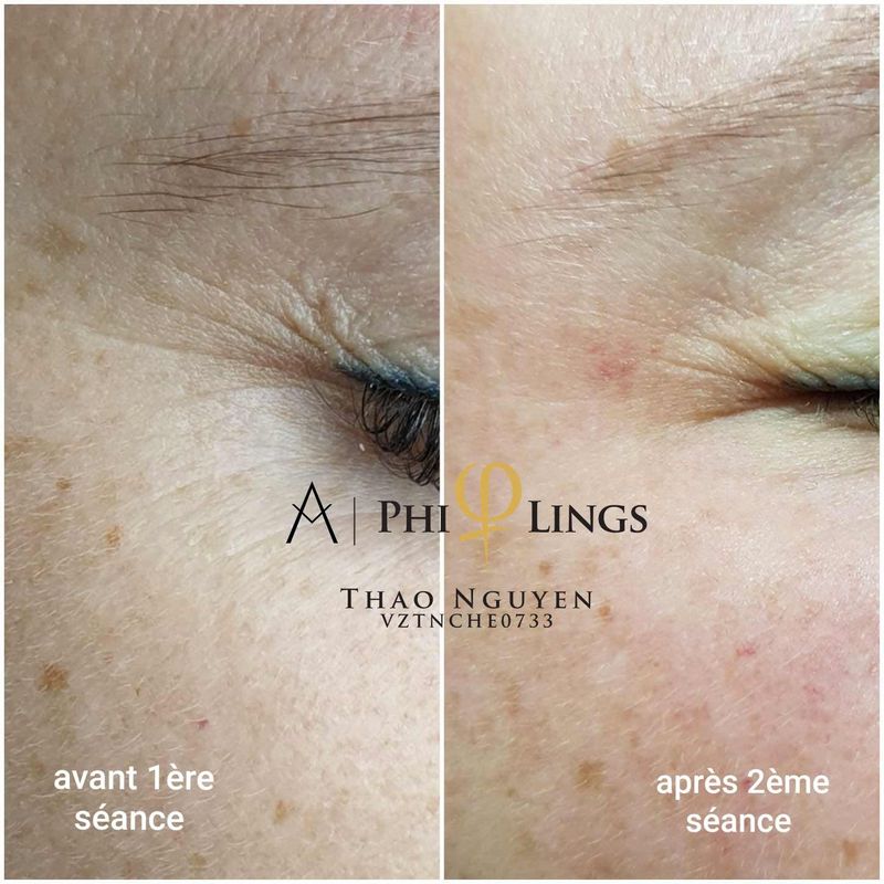 MicroNeedling - before and after, Eye Designer