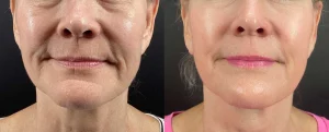Morpheus8, Rejuvenation, Skin, Treatment, Anti-aging, Collagen, Tightening, Microneedling, Lifting, Microneedling with Radiofrequency, Morpheus 8, Eye Designer