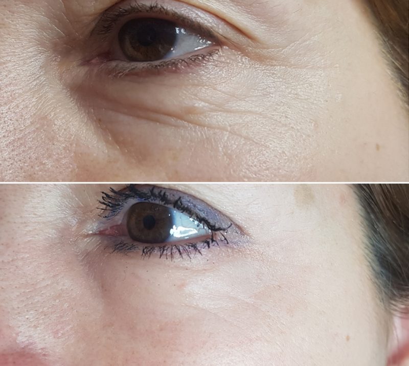 MicroNeedling - Cicatrices d'acné - Genève, Eye Designer