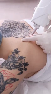 Détatouage au Laser, Picoseconde, Eye Designer