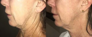 Morpheus 8, Rajeunissement, Peau,Traitement, Anti-âge, Collagène, Tenseur, Microneedling, Lifting, Microneedling avec radiofréquence, Morpheus8, Eye Designer