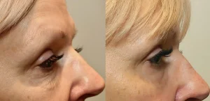 Morpheus 8, Rajeunissement, Peau,Traitement, Anti-âge, Collagène, Tenseur, Microneedling, Lifting, Microneedling avec radiofréquence, Morpheus8, Eye Designer