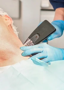 Morpheus 8, Rajeunissement, Peau,Traitement, Anti-âge, Collagène, Tenseur, Microneedling, Lifting, Microneedling avec radiofréquence, Morpheus8, Eye Designer